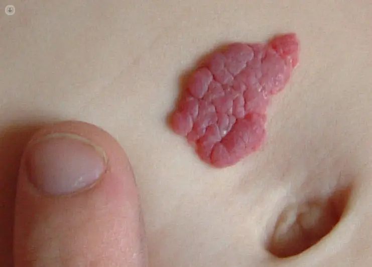 Hemangioma en Adultos: ¿Qué es, Causas, Síntomas y Tratamiento? - Qué tipo de tumor es el hemangioma hemangioma en adultos - Qué tipo de tumor es el hemangioma
