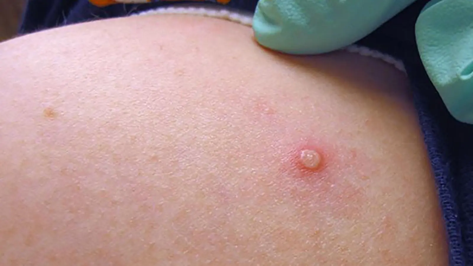 monkeypox - Qué tipo de virus es el monkeypox