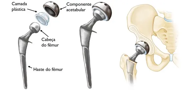 Artroplastia: Reemplazo Articular para una Vida Activa - Qué tipos de artroplastias existen artroplastia - Qué tipos de artroplastias existen
