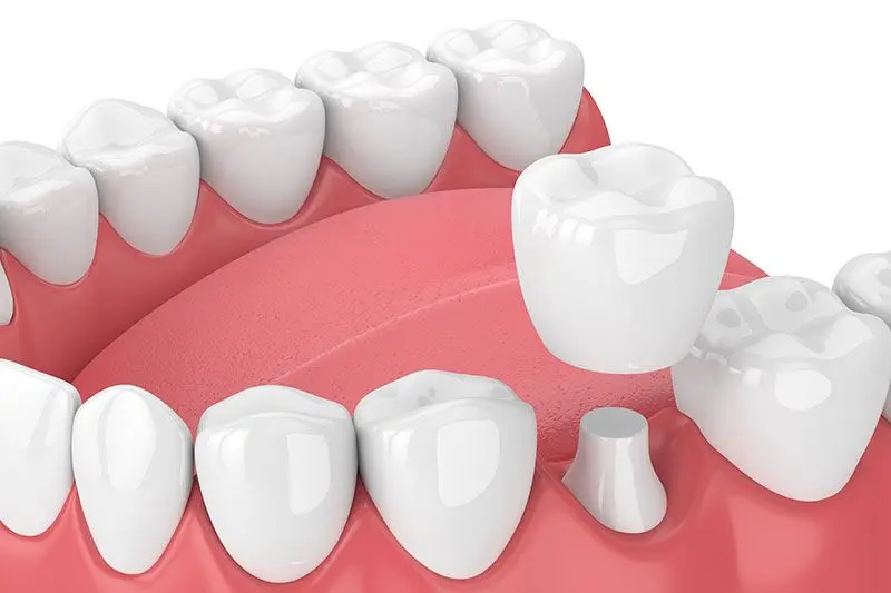 Corona Odontológica: Guía Completa de Tipos y Características - Qué tipos de corona existen corona odontologia - Qué tipos de corona existen