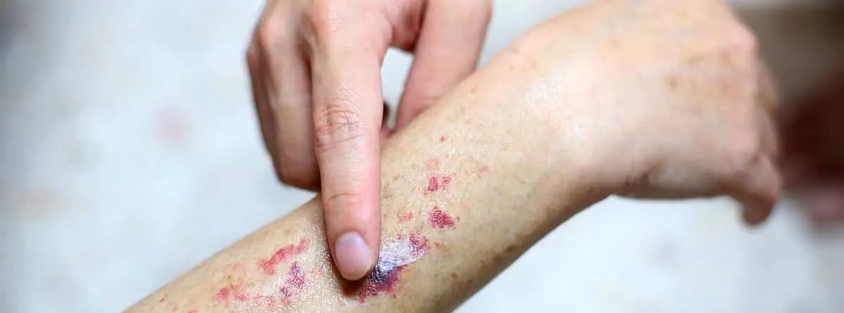 Infecciones en la Sangre: Tipos, Transmisión y Prevención - Qué tipos de infecciones hay en la sangre problemas en la sangre - Qué tipos de infecciones hay en la sangre
