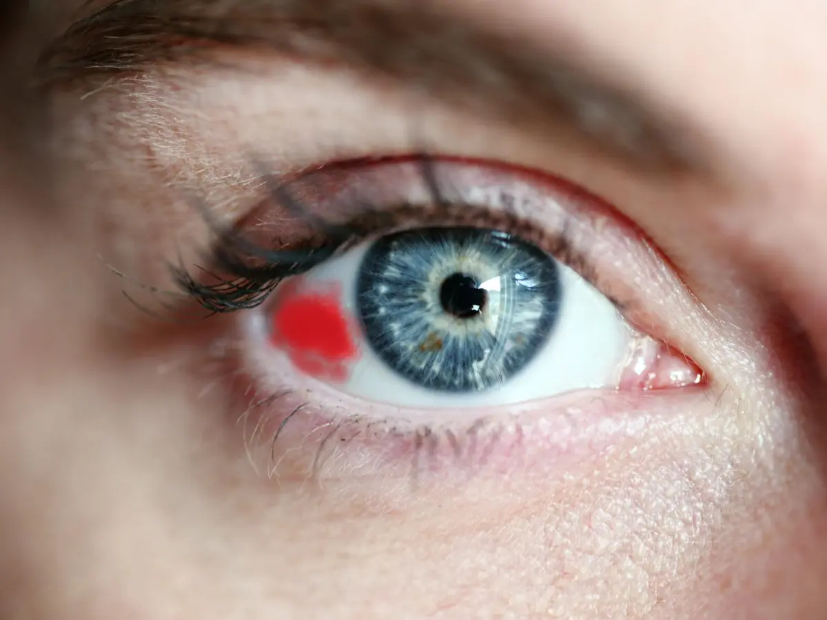 Derrame Ocular: Causas, Síntomas y Tratamiento - Qué tomar para el derrame en el ojo derrame ocular causas - Qué tomar para el derrame en el ojo
