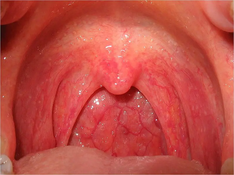 Garganta Irritada: Causas, Síntomas y Remedios - Qué tomar para garganta seca e irritada garganta irritada - Qué tomar para garganta seca e irritada