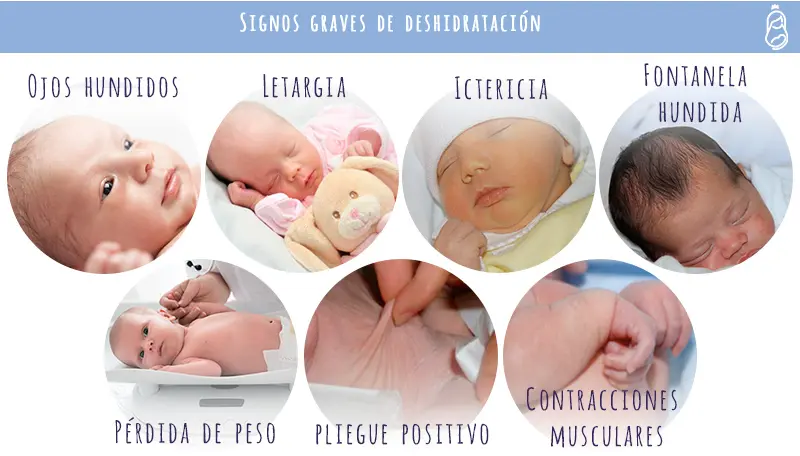 El Signo del Pliegue: Un Indicador de Deshidratación - Qué valores indican deshidratación signo del pliegue - Qué valores indican deshidratación