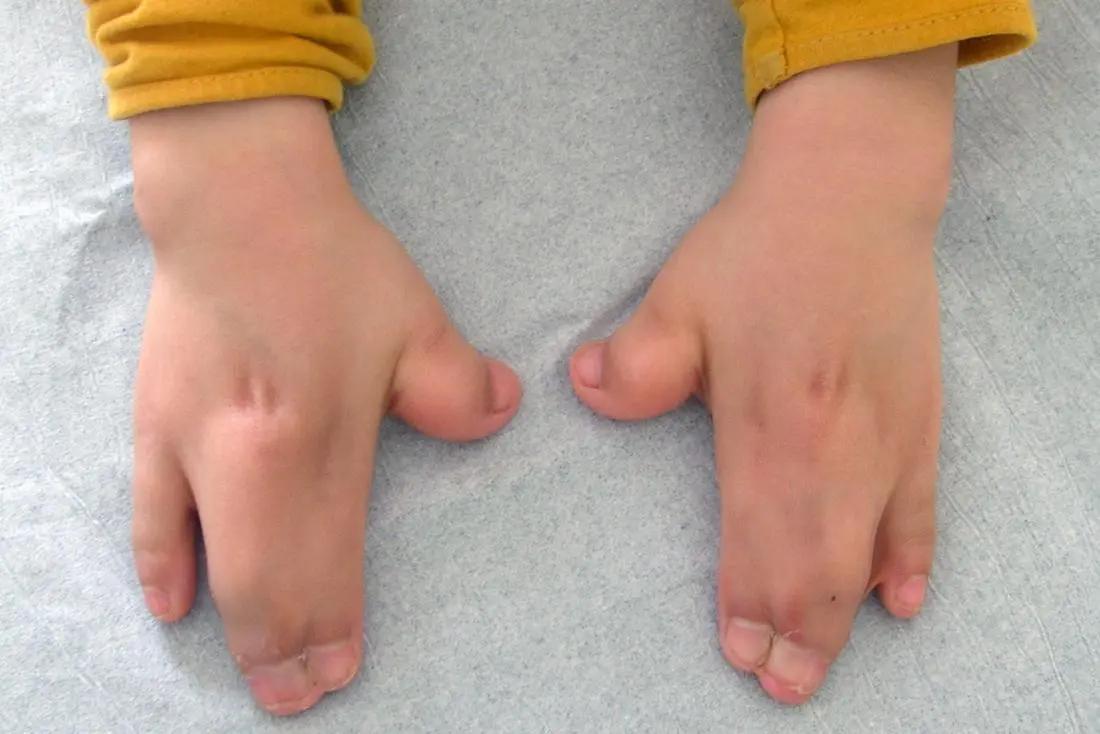 sindrome de apert - Quién descubrió el síndrome de Apert