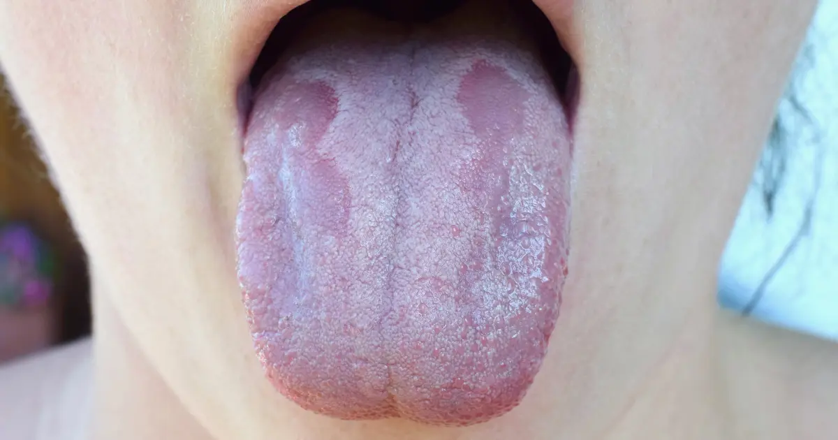 Candidiasis Vulvovaginal: Causas, Síntomas y Tratamiento - Quién es el portador de la cándida la candida es contagiosa - Quién es el portador de la cándida