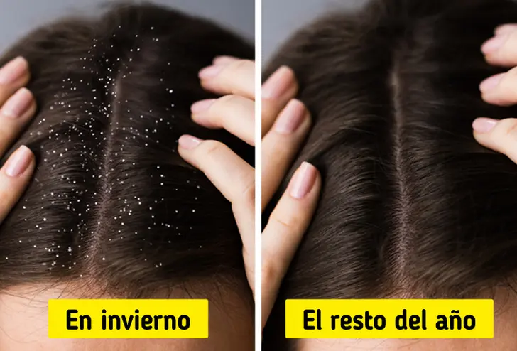 La Caspa: ¿Es Contagiosa o un Mito? - Se puede contagiar la caspa de otra persona la caspa es contagiosa - Se puede contagiar la caspa de otra persona