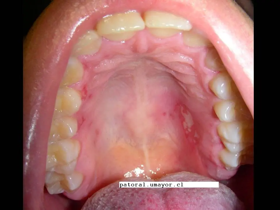 Herpes Zóster en el Paladar: Síntomas, Causas y Tratamiento - Se puede desarrollar herpes zóster en el paladar herpes zoster en el paladar - Se puede desarrollar herpes zóster en el paladar